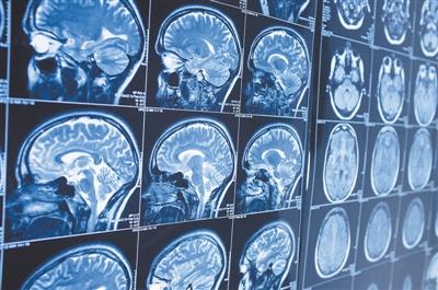 AI the Anticipates Diagnosis of Alzheimer’s disease